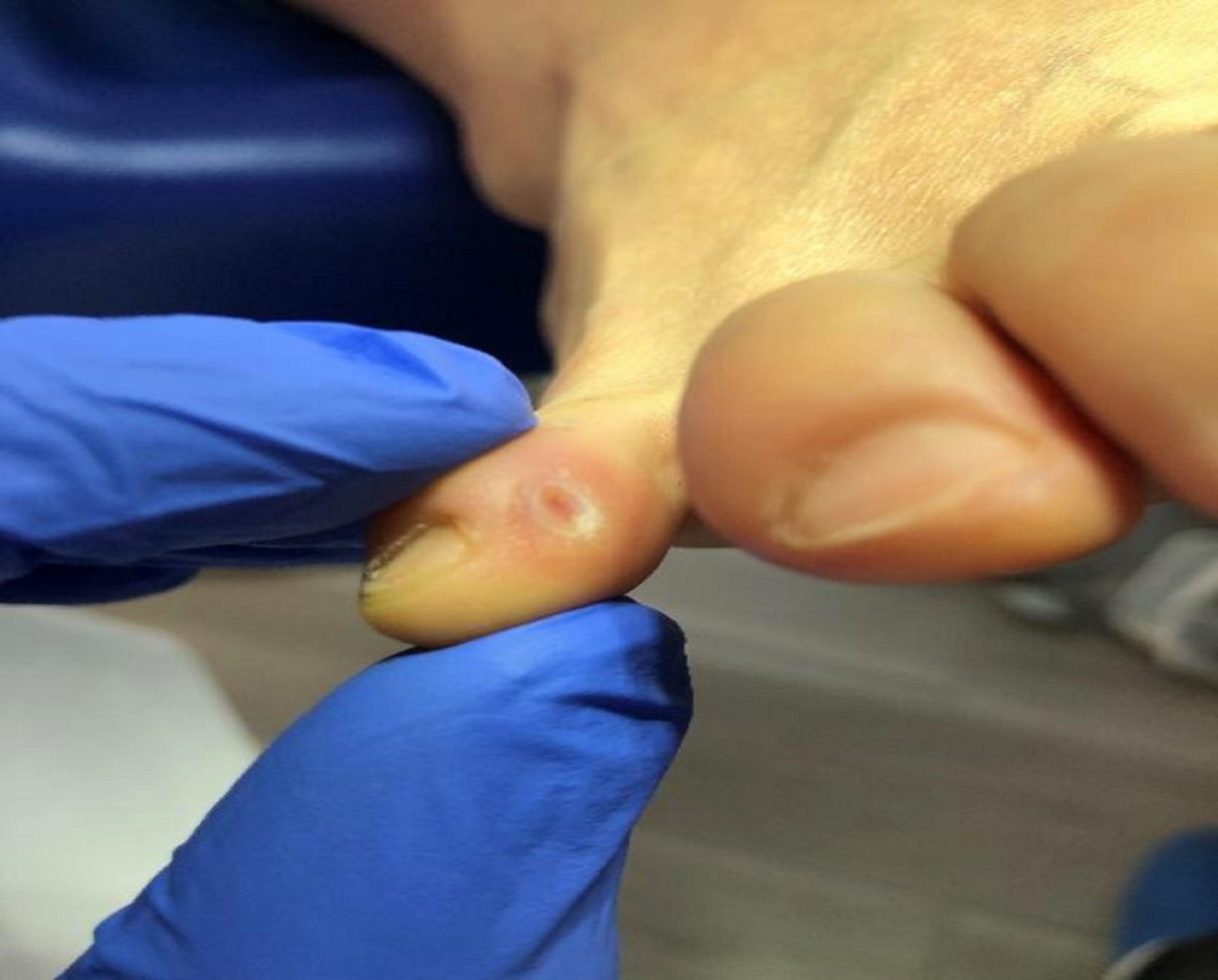 trattamento laser piede podologo saronno