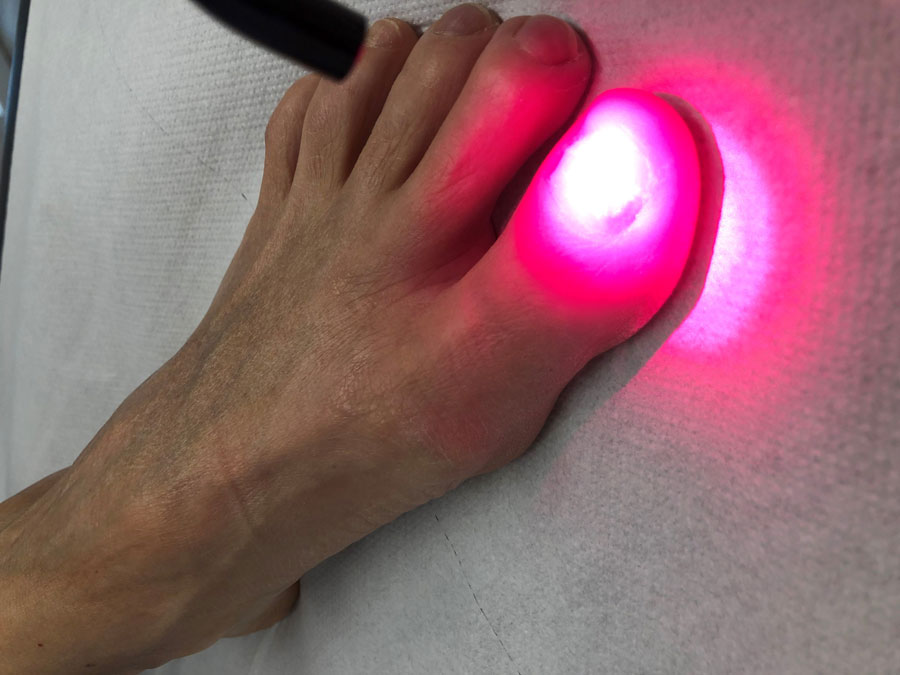 laserterapia piede
